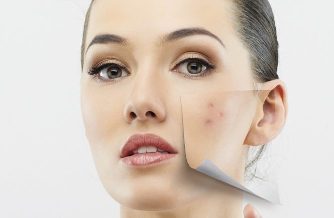 A pele oleosa tende a sofrer com aparecimento de acne as estações mais frias