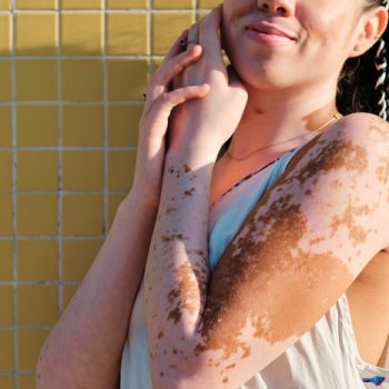 vitiligo