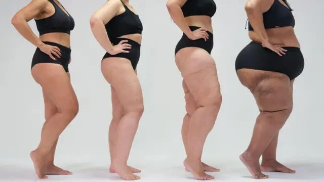 lipedema