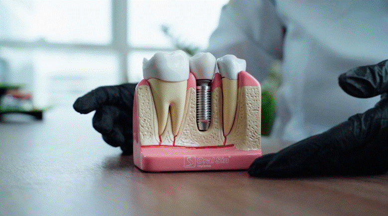 img-implante-01 implante