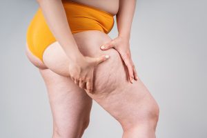 lipedema